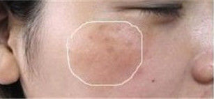 High purity white color Oligopeptide-10 Granactive ACNE for anti-acne cas466691-40-7